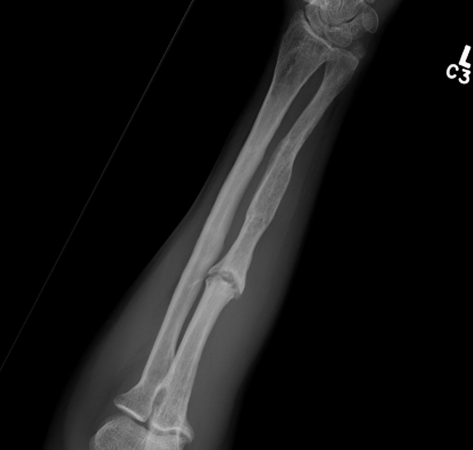 Ulna Non Union